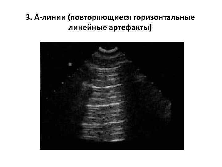 3. А-линии (повторяющиеся горизонтальные линейные артефакты) 