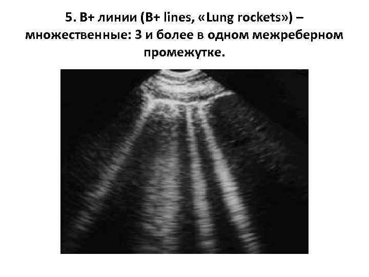 5. В+ линии (В+ lines, «Lung rockets» ) – множественные: 3 и более в