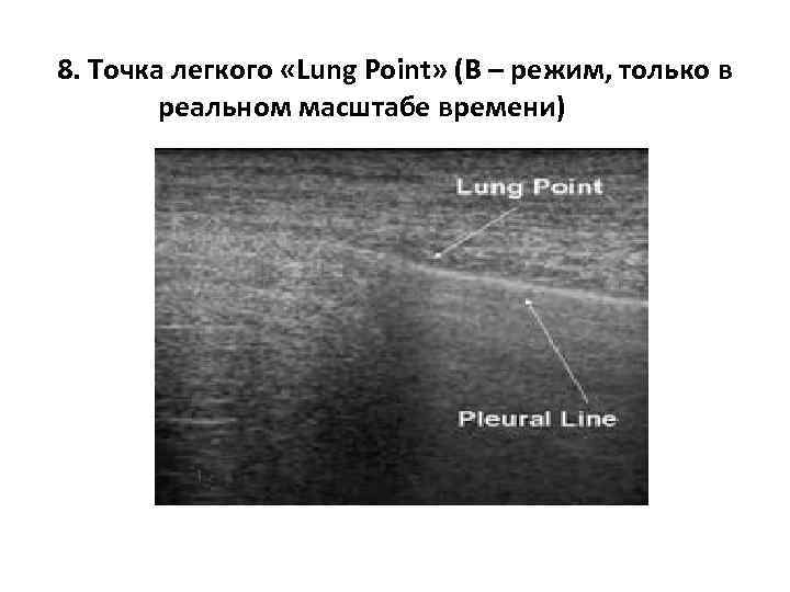 8. Точка легкого «Lung Point» (В – режим, только в реальном масштабе времени) 