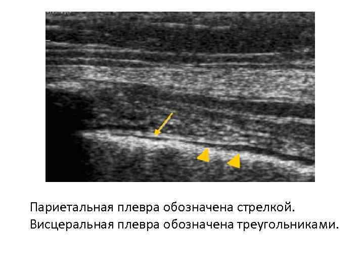 Париетальная плевра обозначена стрелкой. Висцеральная плевра обозначена треугольниками. 