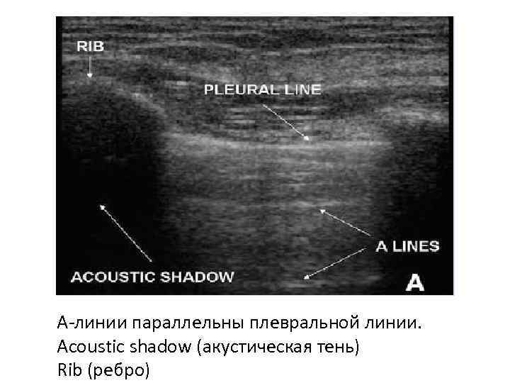 А-линии параллельны плевральной линии. Acoustic shadow (акустическая тень) Rib (ребро) 