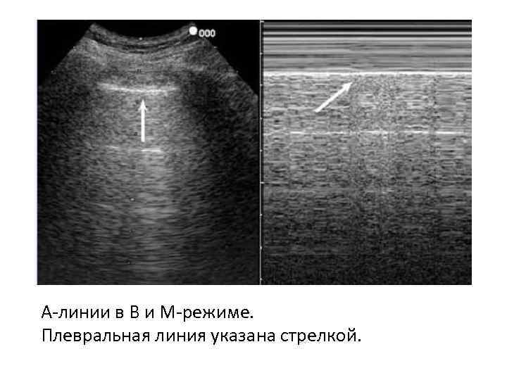 А-линии в В и М-режиме. Плевральная линия указана стрелкой. 
