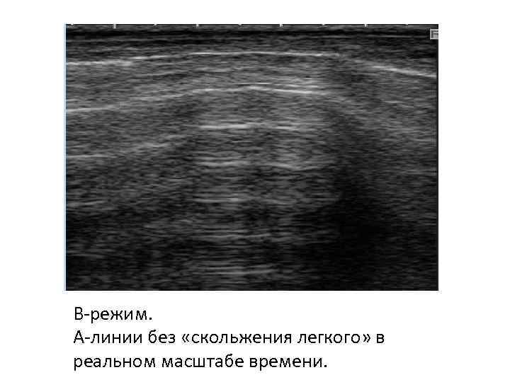 В-режим. А-линии без «скольжения легкого» в реальном масштабе времени. 