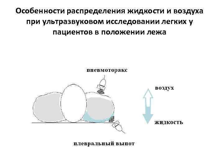 Особенности распределения жидкости и воздуха при ультразвуковом исследовании легких у пациентов в положении лежа