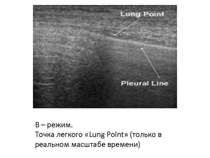 В – режим. Точка легкого «Lung Point» (только в реальном масштабе времени) 