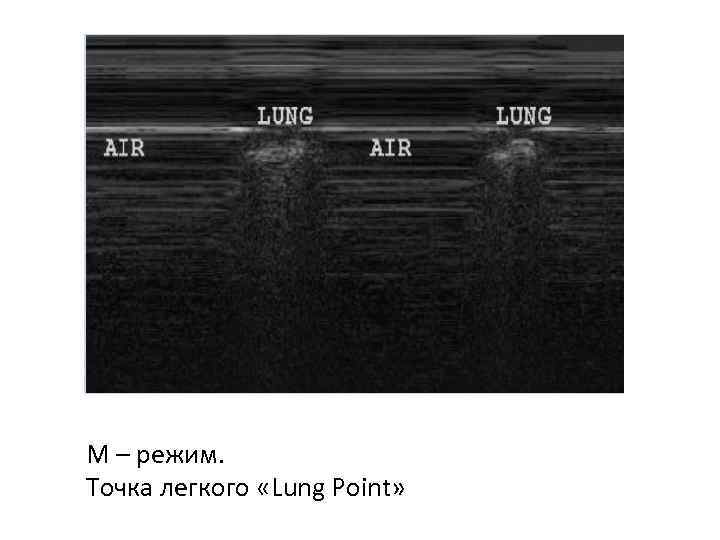 М – режим. Точка легкого «Lung Point» 