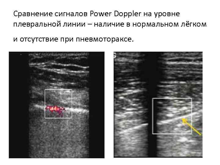 Сравнение сигналов Рower Doppler на уровне плевральной линии – наличие в нормальном лёгком и