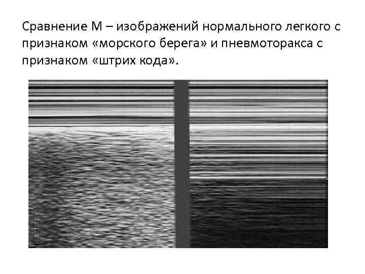 Сравнение М – изображений нормального легкого с признаком «морского берега» и пневмоторакса с признаком