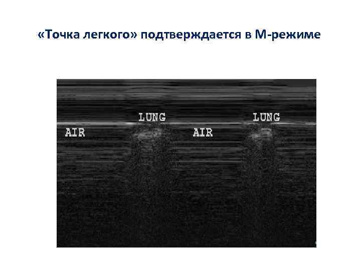  «Точка легкого» подтверждается в М-режиме 