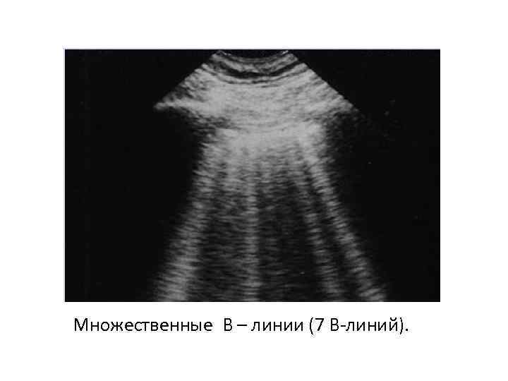 Множественные В – линии (7 В-линий). 