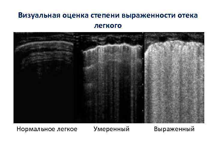 Визуальная оценка степени выраженности отека легкого Нормальное легкое Умеренный Выраженный 