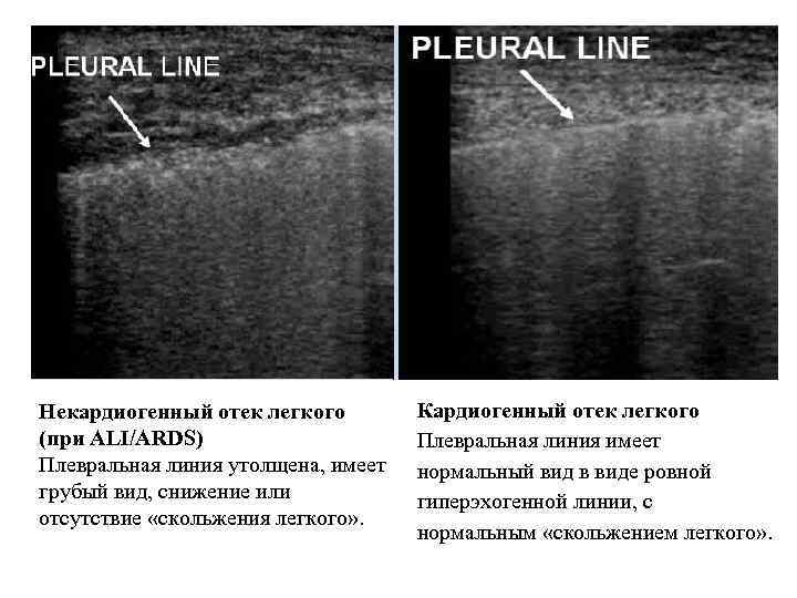  Некардиогенный отек легкого (при ALI/ARDS) Плевральная линия утолщена, имеет грубый вид, снижение или