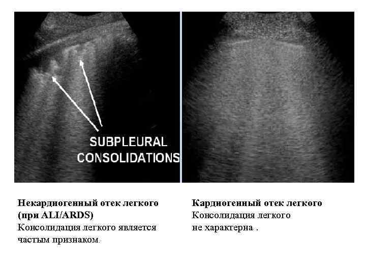 Некардиогенный отек легкого (при ALI/ARDS) Консолидация легкого является частым признаком. Кардиогенный отек легкого Консолидация