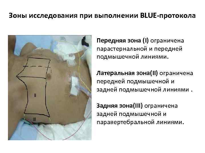 Зоны исследования при выполнении BLUE-протокола Передняя зона (I) ограничена парастернальной и передней подмышечной линиями.