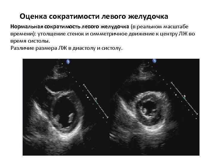 Оценка сократимости левого желудочка Нормальная сократимость левого желудочка (в реальном масштабе времени): утолщение стенок