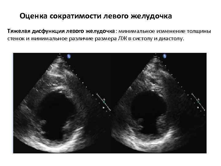 Оценка сократимости левого желудочка Тяжелая дисфункция левого желудочка: минимальное изменение толщины стенок и минимальное