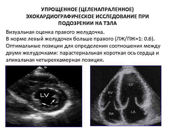 УПРОЩЕННОЕ (ЦЕЛЕНАПРАЛЕННОЕ) ЭХОКАРДИОГРАФИЧЕСКОЕ ИССЛЕДОВАНИЕ ПРИ ПОДОЗРЕНИИ НА ТЭЛА Визуальная оценка правого желудочка. В норме