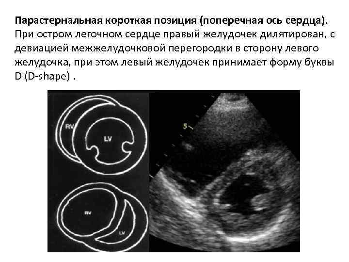 Парастернальная короткая позиция (поперечная ось сердца). При остром легочном сердце правый желудочек дилятирован, с