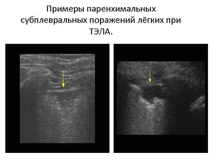 Примеры паренхимальных субплевральных поражений лёгких при ТЭЛА. 