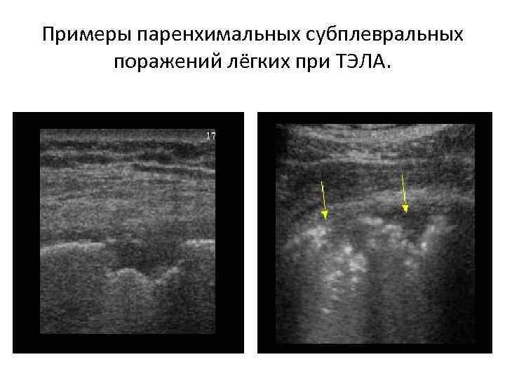 Примеры паренхимальных субплевральных поражений лёгких при ТЭЛА. 