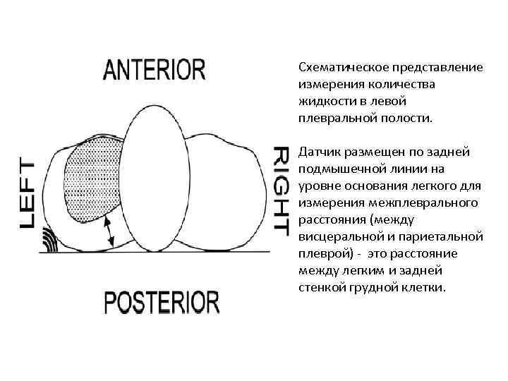 Схематическое представление измерения количества жидкости в левой плевральной полости. Датчик размещен по задней подмышечной