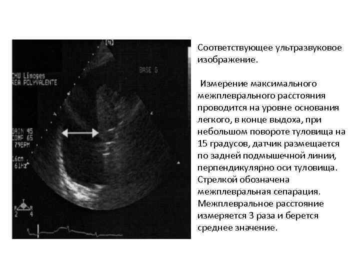 Соответствующее ультразвуковое изображение. Измерение максимального межплеврального расстояния проводится на уровне основания легкого, в конце