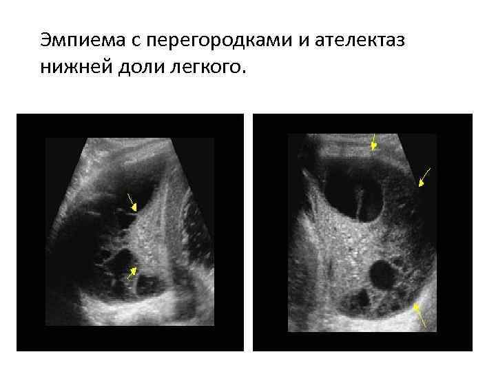 Эмпиема с перегородками и ателектаз нижней доли легкого. 