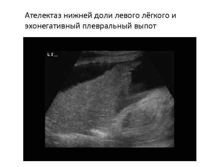 Ателектаз нижней доли левого лёгкого и эхонегативный плевральный выпот 