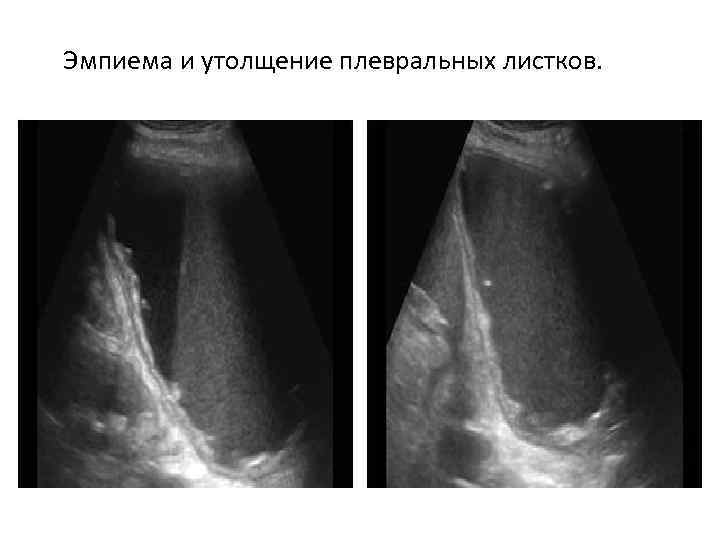 Эмпиема и утолщение плевральных листков. 