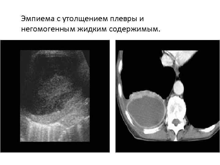 Эмпиема с утолщением плевры и негомогенным жидким содержимым. 