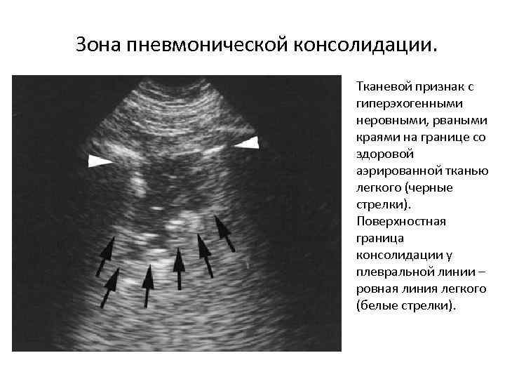 Зона пневмонической консолидации. Тканевой признак с гиперэхогенными неровными, рваными краями на границе со здоровой