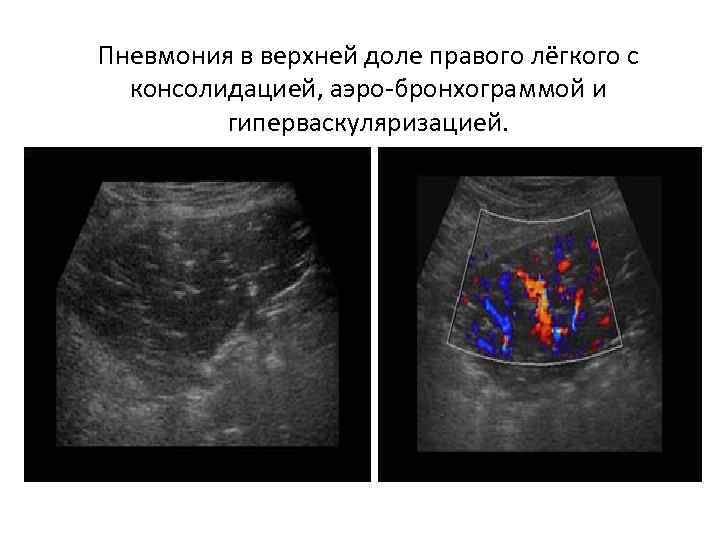 Пневмония в верхней доле правого лёгкого с консолидацией, аэро-бронхограммой и гиперваскуляризацией. 