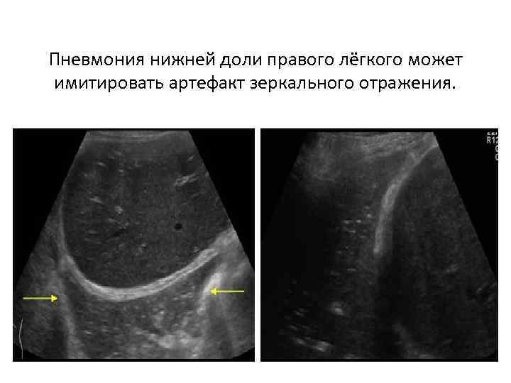 Пневмония нижней доли правого лёгкого может имитировать артефакт зеркального отражения. 