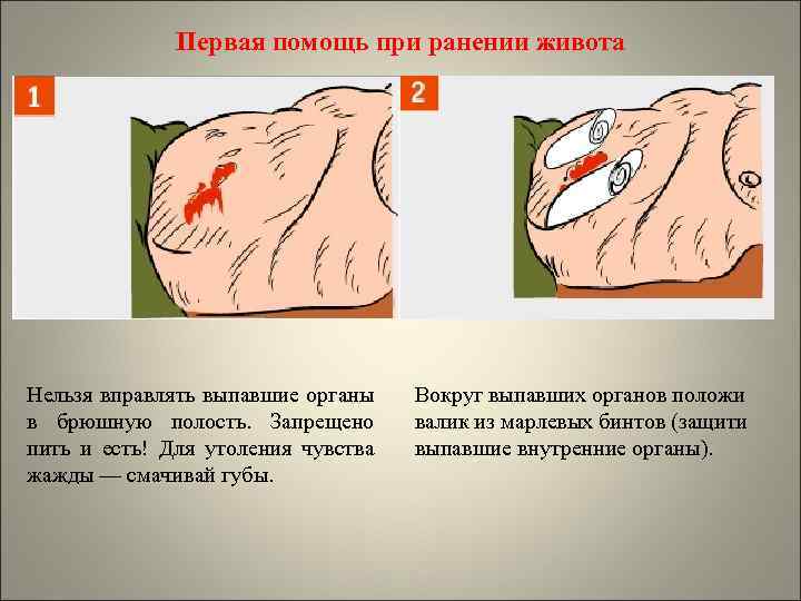 Первая помощь при ранении живота Нельзя вправлять выпавшие органы в брюшную полость. Запрещено пить