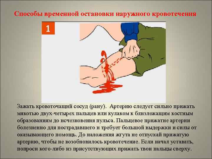 Способы временной остановки наружного кровотечения Зажать кровоточащий сосуд (рану). Артерию следует сильно прижать мякотью