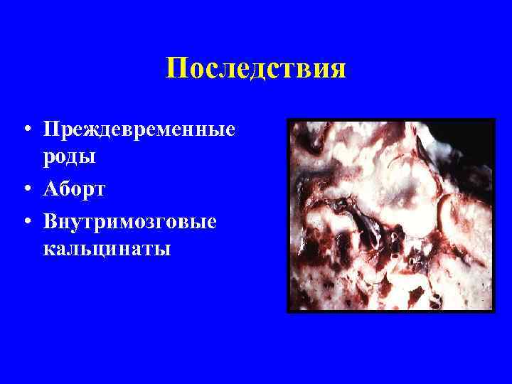 Последствия • Преждевременные роды • Аборт • Внутримозговые кальцинаты 