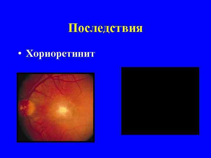 Последствия • Хориоретинит 