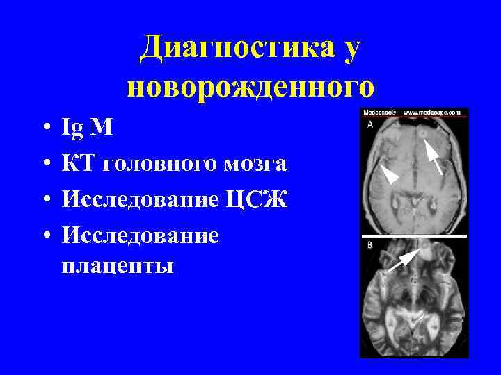 Диагностика у новорожденного • • Ig M КТ головного мозга Исследование ЦСЖ Исследование плаценты