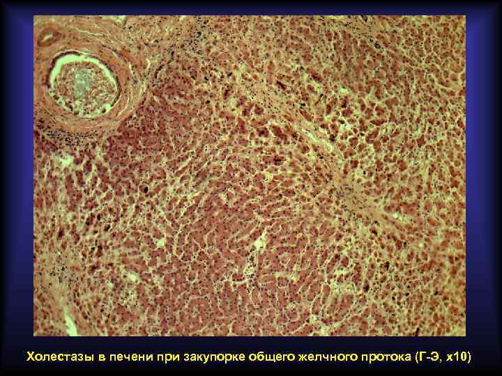 Холестазы в печени при закупорке общего желчного протока (Г-Э, х10) 