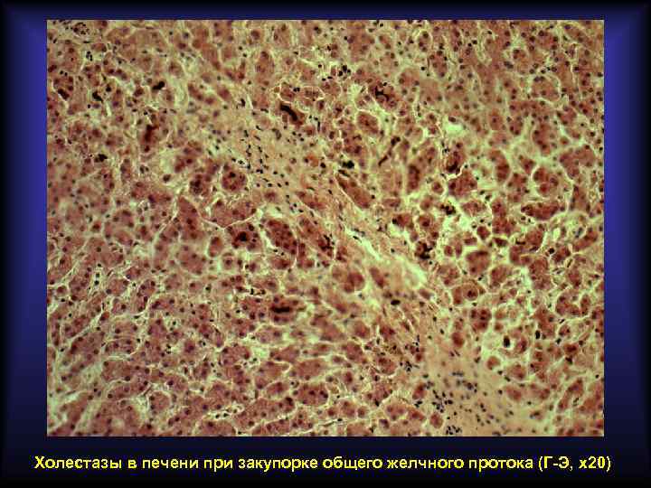 Холестазы в печени при закупорке общего желчного протока (Г-Э, х20) 