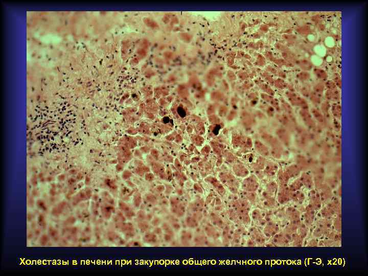 Холестазы в печени при закупорке общего желчного протока (Г-Э, х20) 
