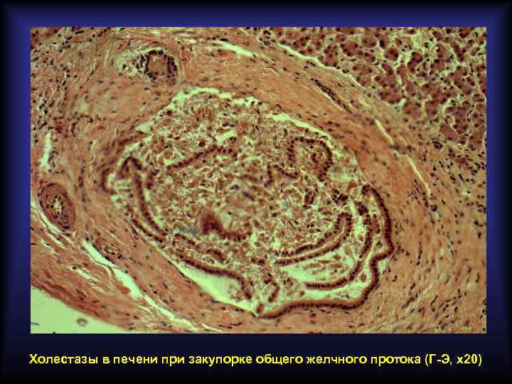 Холестазы в печени при закупорке общего желчного протока (Г-Э, х20) 