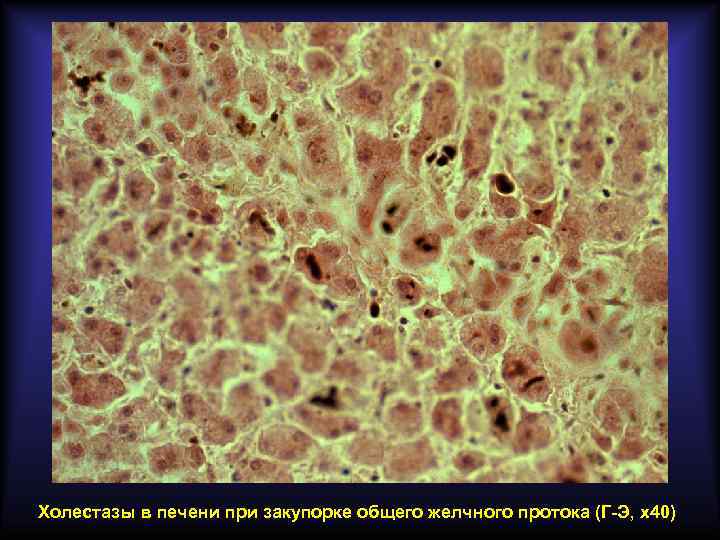 Холестазы в печени при закупорке общего желчного протока (Г-Э, х40) 