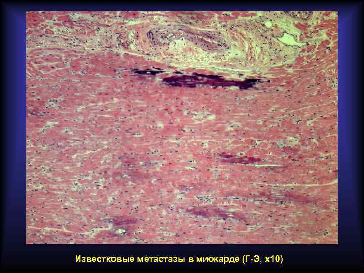 Известковые метастазы в миокарде (Г-Э, х10) 