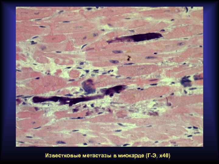 Известковые метастазы в миокарде (Г-Э, х40) 