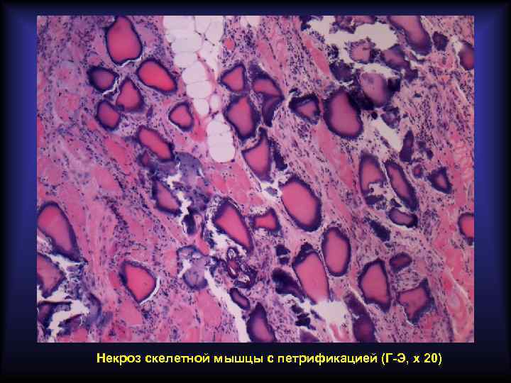 Некроз скелетной мышцы с петрификацией (Г-Э, х 20) 