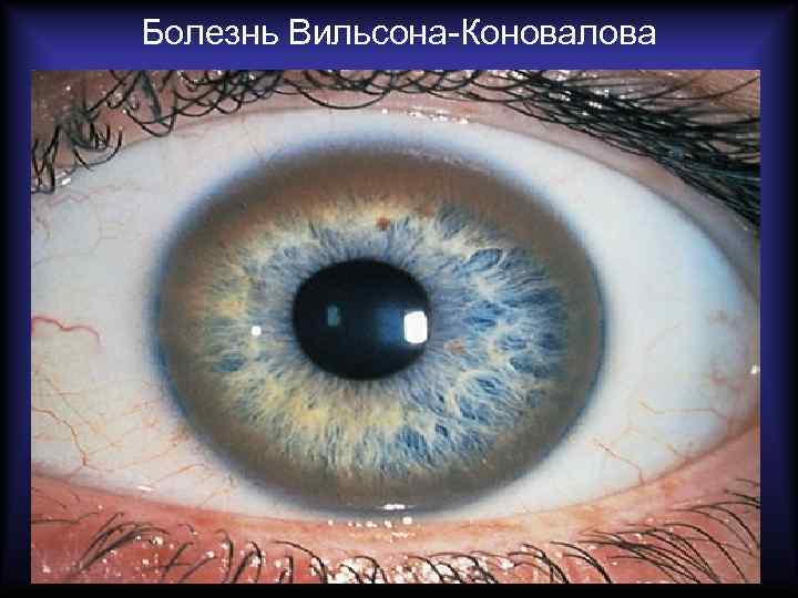 Болезнь Вильсона-Коновалова 