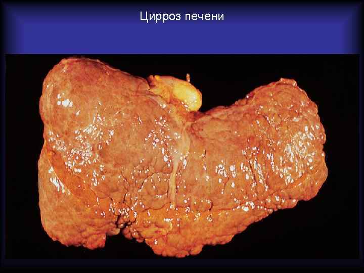 Цирроз печени 