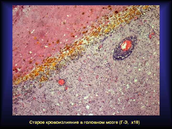 Старое кровоизлияние в головном мозге (Г-Э, х10) 