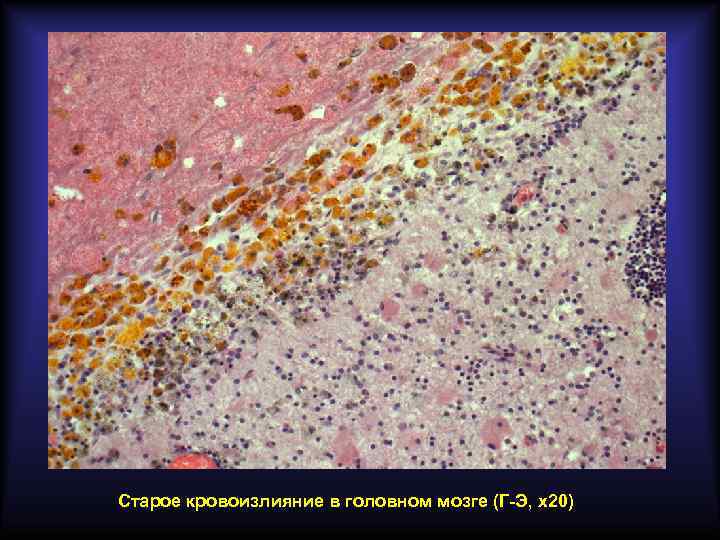 Старое кровоизлияние в головном мозге (Г-Э, х20) 